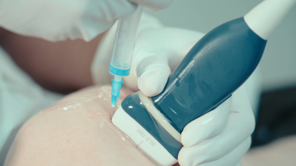 Ultrasound-guided injection, with the needle placed alongside the ultrasound probe